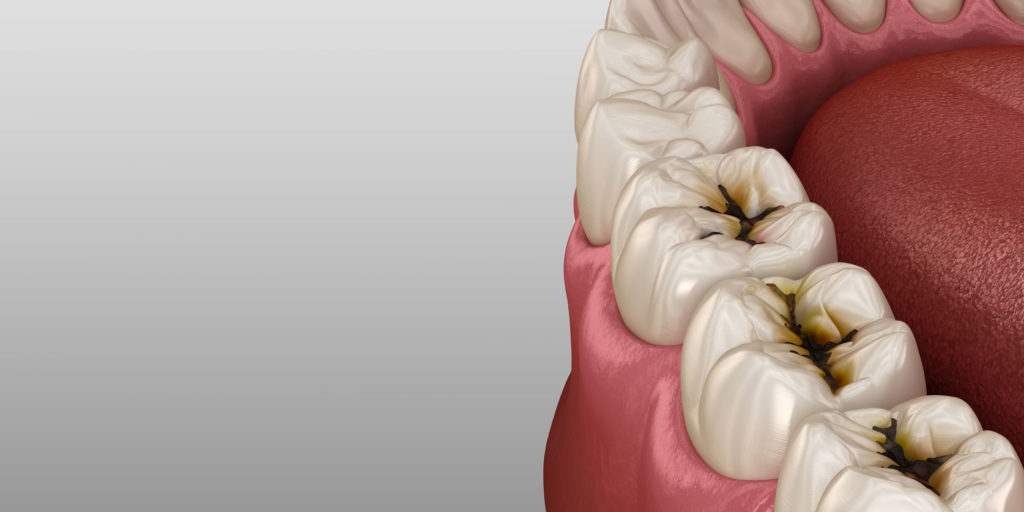 dental cavity graphic