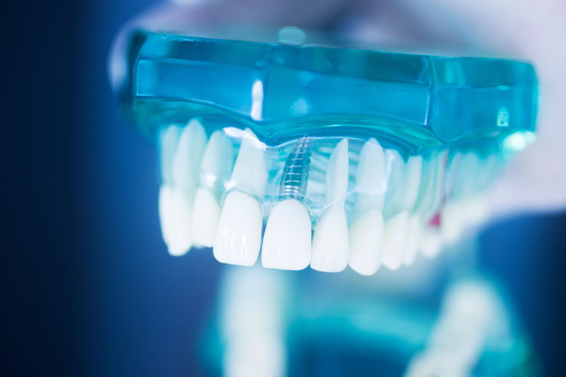 Discover the Promising World of Teeth Implants in Troy, IL