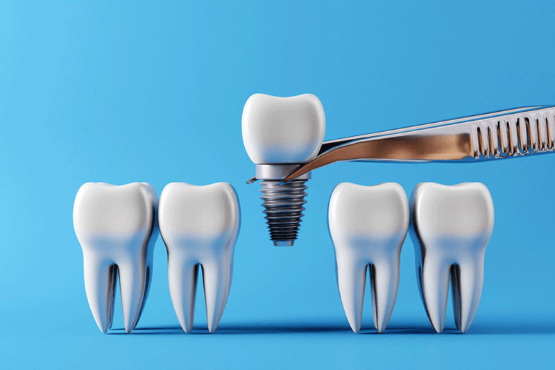 Dental teeth implants and Healthy white teeth. Oral health and dental inspection teeth.