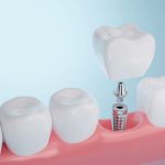 Healthy gums and Dental implant on blue background. 3D rendering