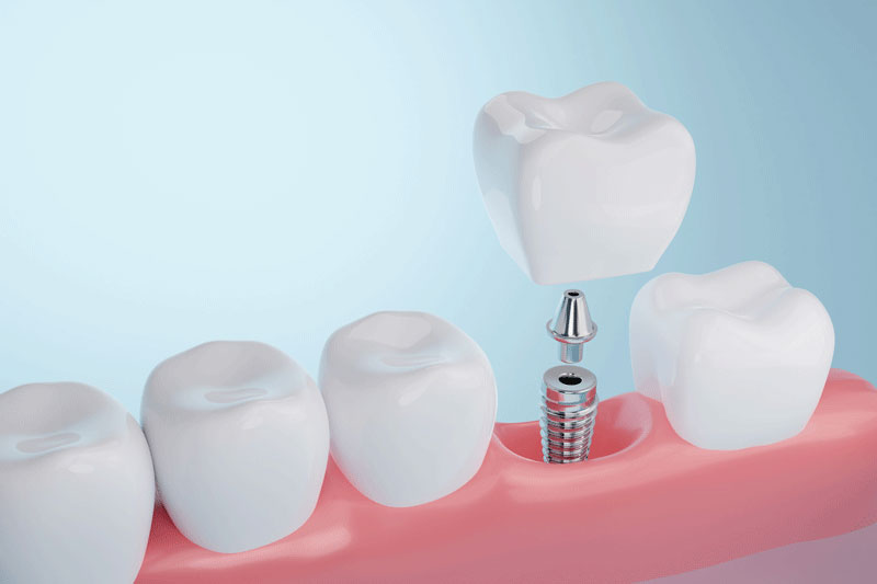 Unlock the Benefits of Dental Implants: Your Best Teeth Replacement Option