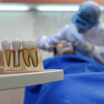 Capped dental implant model on desk in dentists’ office with copy space. Focusing shoot on dental implant model.