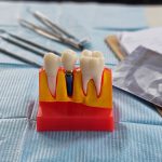 Dental implant, artificial tooth roots into jaw, root canal of dental treatment, gum disease, teeth model for dentist