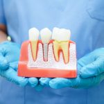 Doctor hold dental implant, artificial tooth roots into jaw, root canal of dental treatment, gum disease, teeth model for dentist studying about dentistry