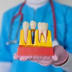 Dentist demonstrates dental implants and crown models in a clinical setting during consultation.