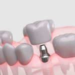 Highly detailed 3D illustration showing a dental implant in place within the jawbone and gum tissue.