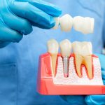 Dentist holding a dental implants model with blue gloves on in a dental office