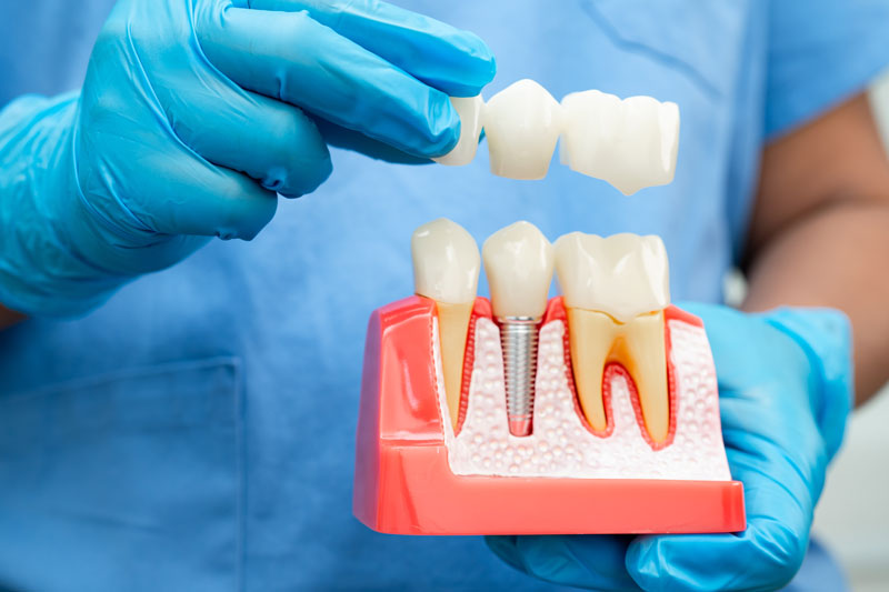 Demystifying Dental Implants: What Is a Tooth Implant Procedure Explained