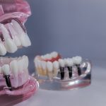 Image of a dentist explaining the lifespan of a dental implant to a patient using a model of a jaw with implants. No text on image.